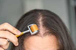 ¿Se puede recuperar el cabello sin cirugía? Opciones reales